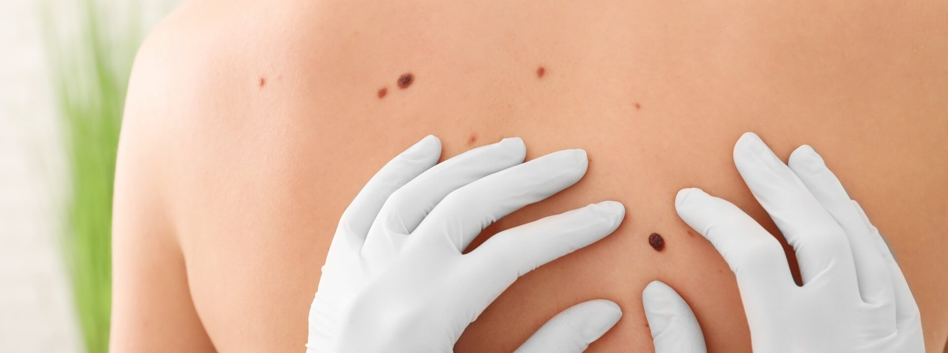 Skin Cancer
Treatment